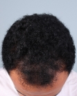Before Hair Transplant&nbsp;Front